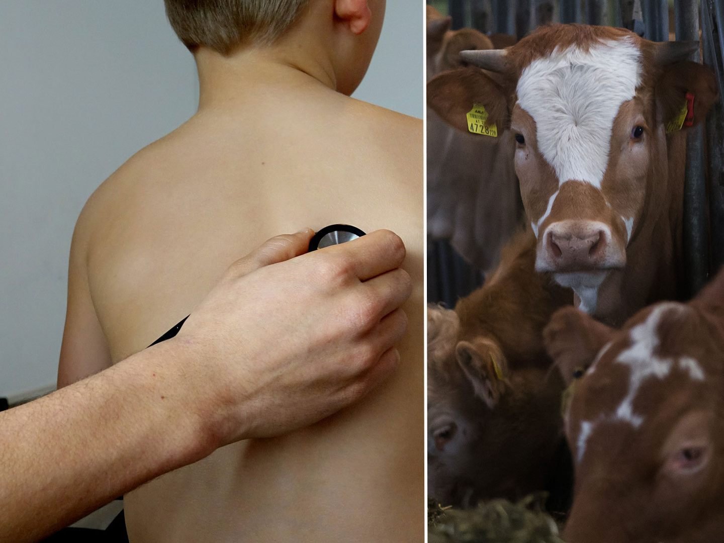 Jetzt ist klar: Das Kind ist an Tuberkulose erkrankt./Symbolbild