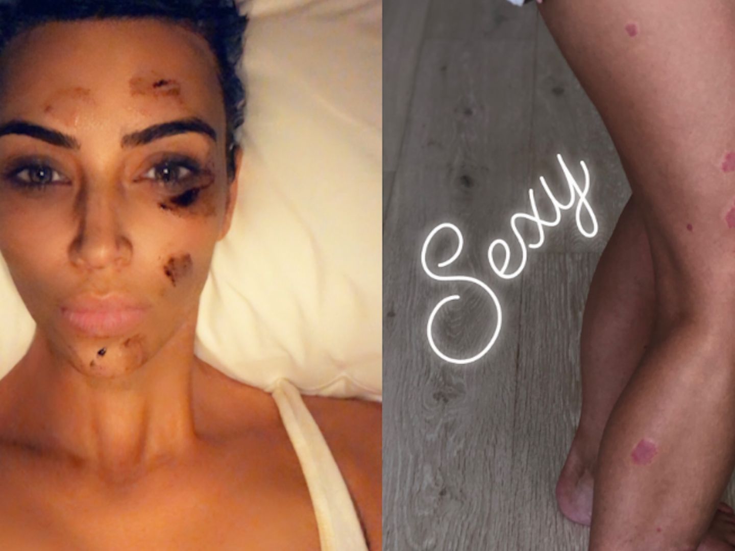 Kim Kardashian leidet unter Schuppenflechte.