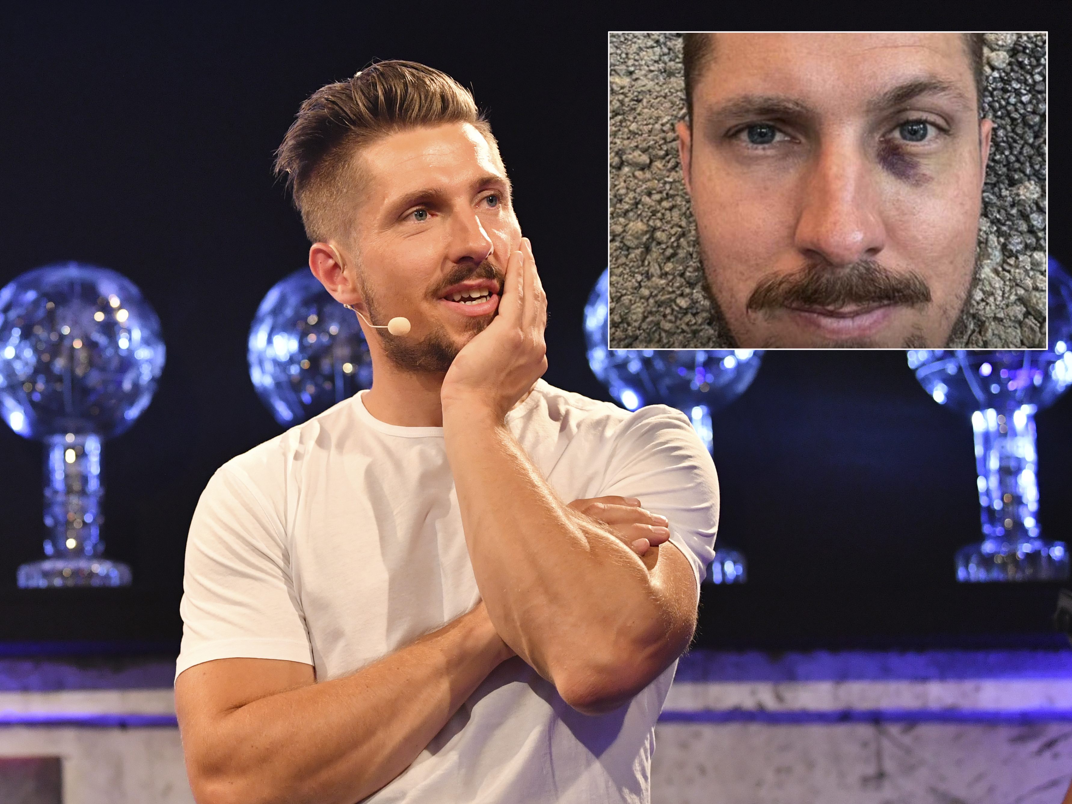 Ex-Skistar Marcel Hirscher hat sich bei einem Sturz ein blaues Auge geholt.