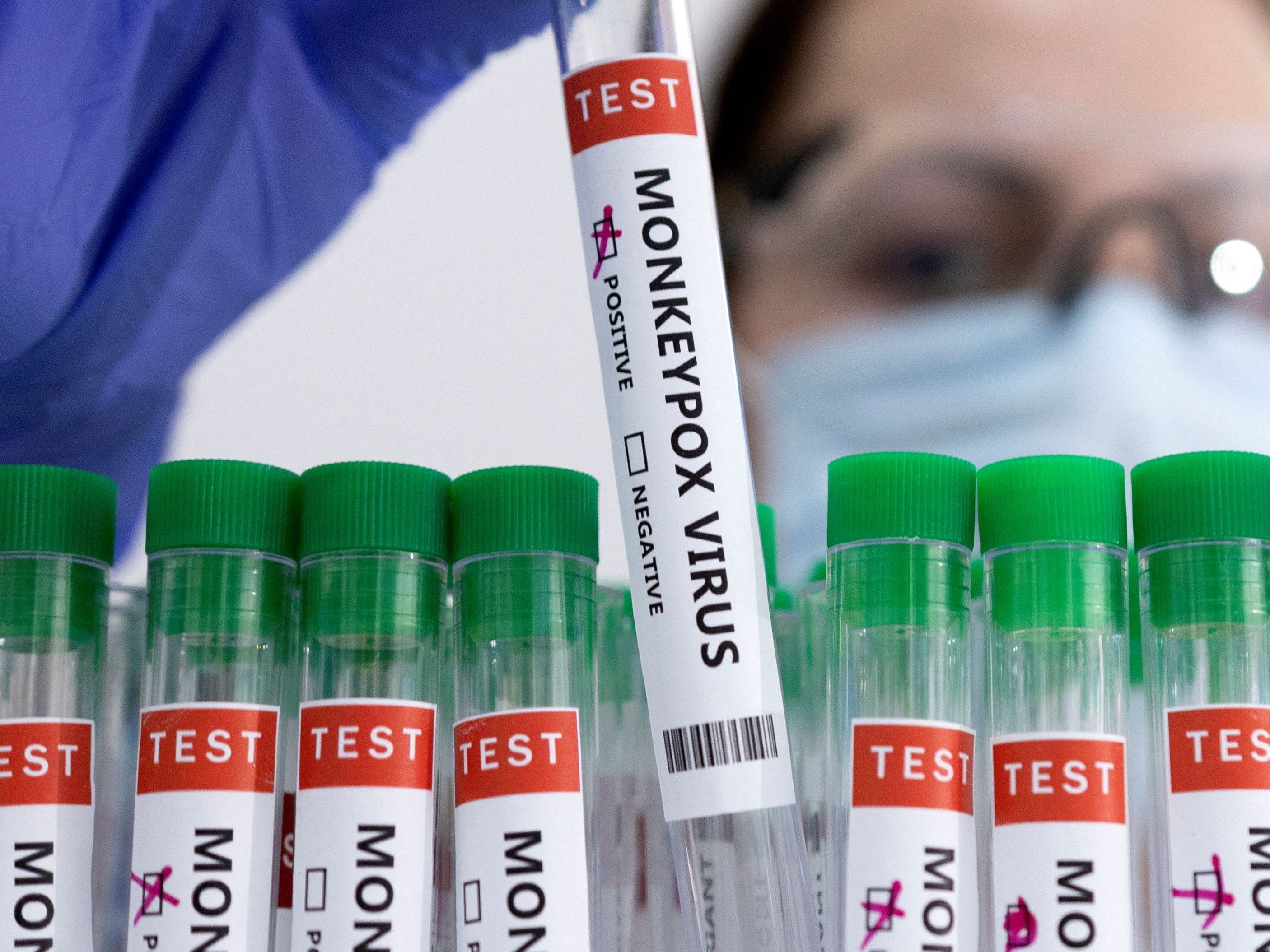 In Europa wurden bislang insgesamt 191 Fälle von Affenpocken bestätigt.