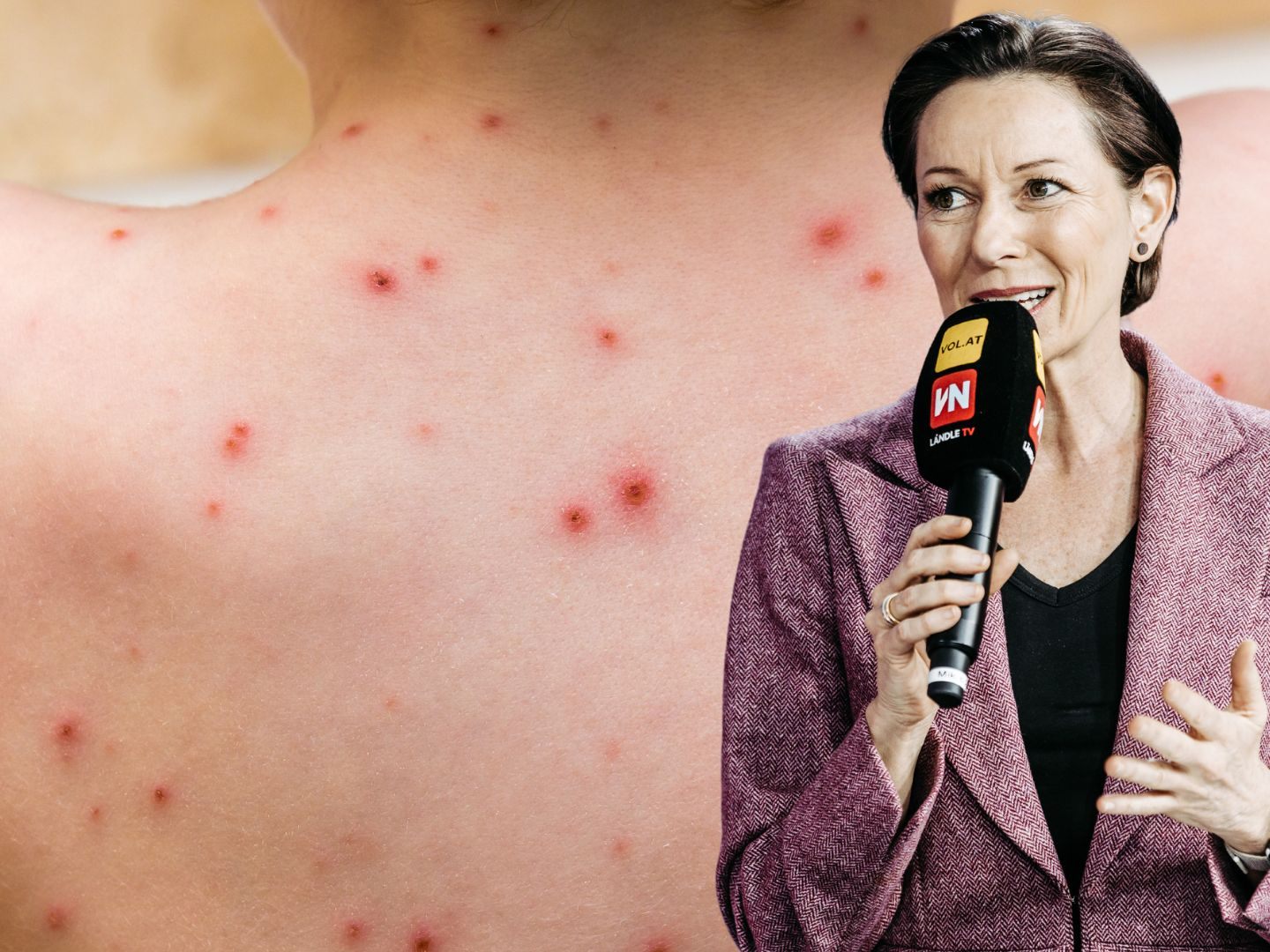 Laut Landesrätin Martina Rüscher wurde der erste Affenpocken-Fall in Vorarlberg bestätigt.