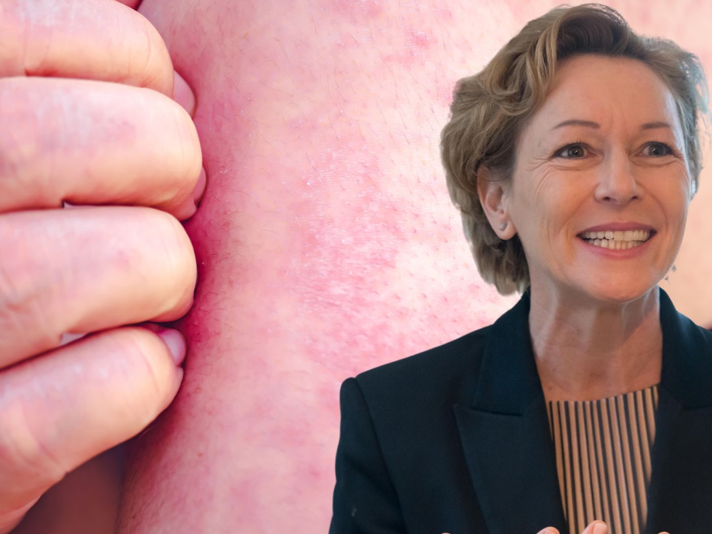 Wie Landesrätin Rüscher bekannt gibt, wurden in Vorarlberg zwei weitere Masernfälle verzeichnet.