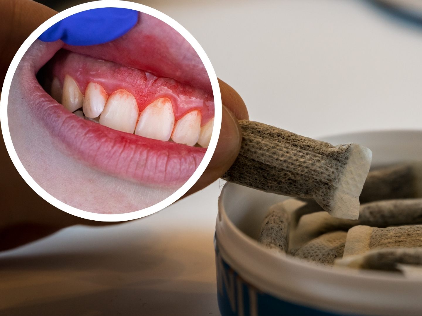 Gravierende Folgen durch den Konsum von Snus (Symbolbild)
