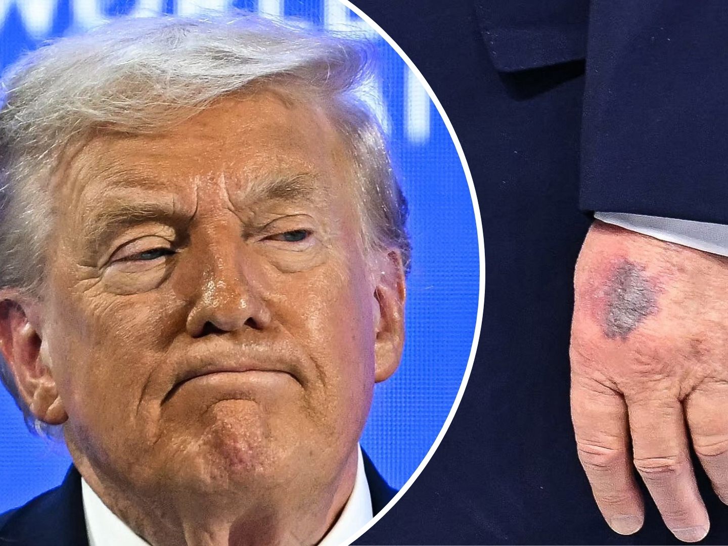 Beim Weltwirtschaftsforum in Davos ist ein dunkler Bluterguss am linken Handrücken von US-Präsident Donald Trump deutlich zu erkennen.