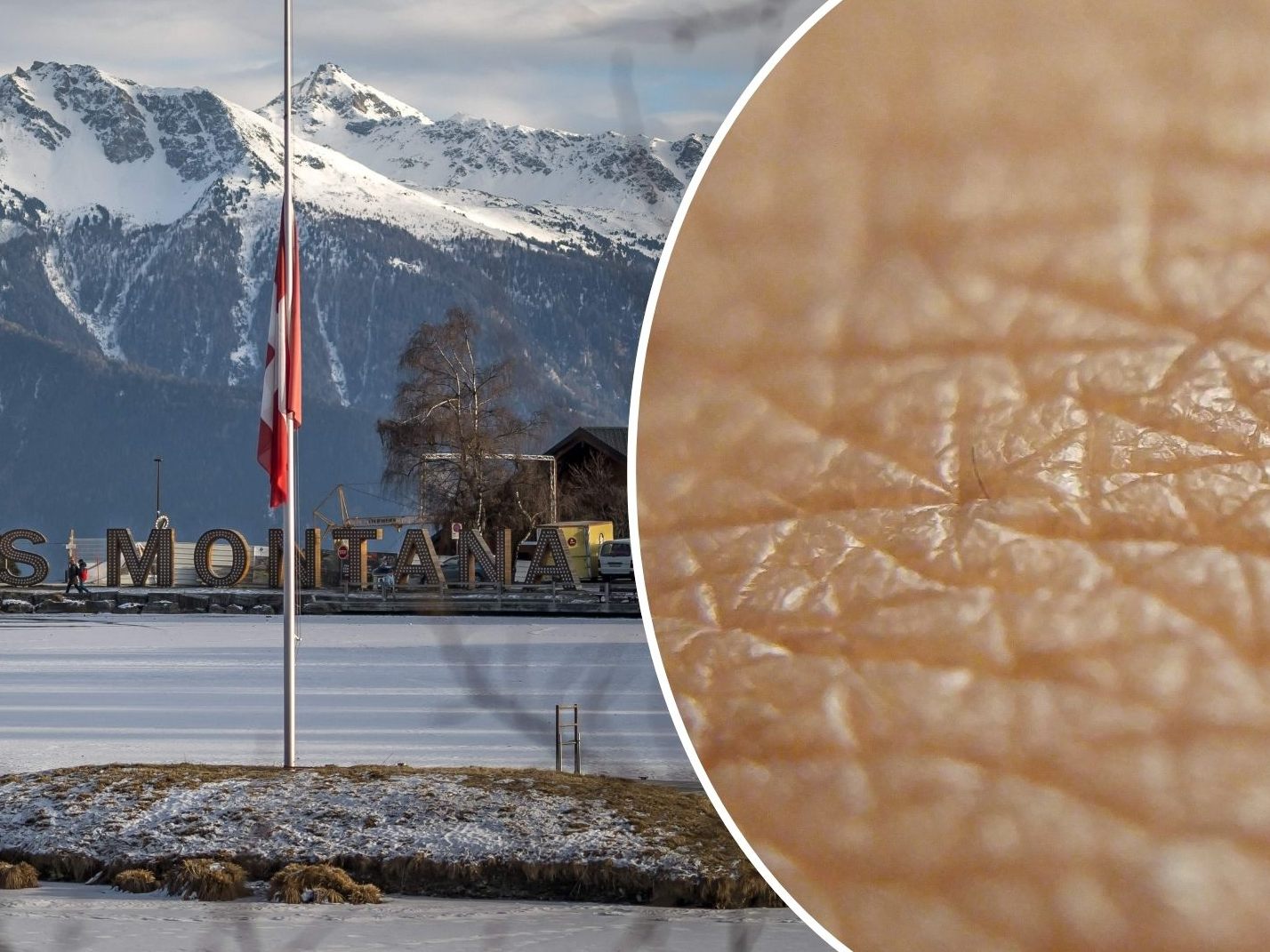 Zürcher Spitäler haben aus den Niederlanden 9,3 Quadratmeter Spenderhaut für Opfer der Brandkatastrophe im Skiort Crans-Montana erhalten.