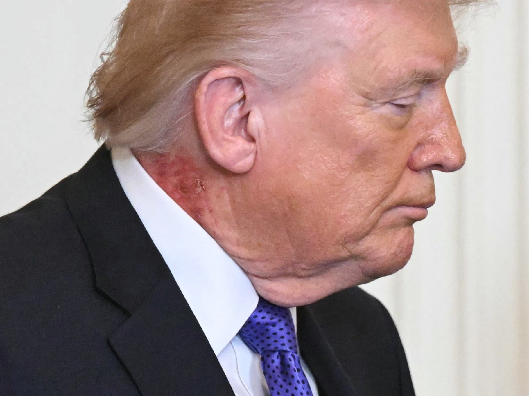 US-Präsident Donald Trump bei der Verleihung der "Medal of Honor" im Weißen Haus mit sichtbarer Hautrötung am Hals.